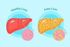 dietitian for fatty liver in near me bandra Mumbai