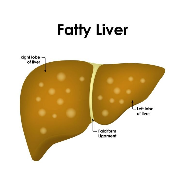 Dietitian for Fatty Liver in Charni Road Mumbai